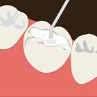 Composite Dental Fillings Etobicoke